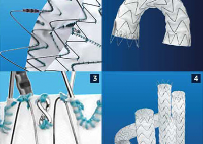 STENT-INJERTO AORTA TORÁCICA / DE NITINOL VALIANT® CAPTIVIA®