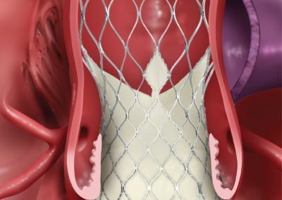 https://sisbc.com/wp-content/uploads/2020/01/EVOLUT-R-SYSTEM-Transcatheter-Aortic-Valve-Replacement-TAVR.pdf