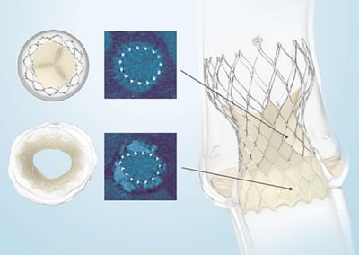 https://sisbc.com/wp-content/uploads/2020/01/EVOLUT-R-SYSTEM-Transcatheter-Aortic-Valve-Replacement-TAVR.pdf